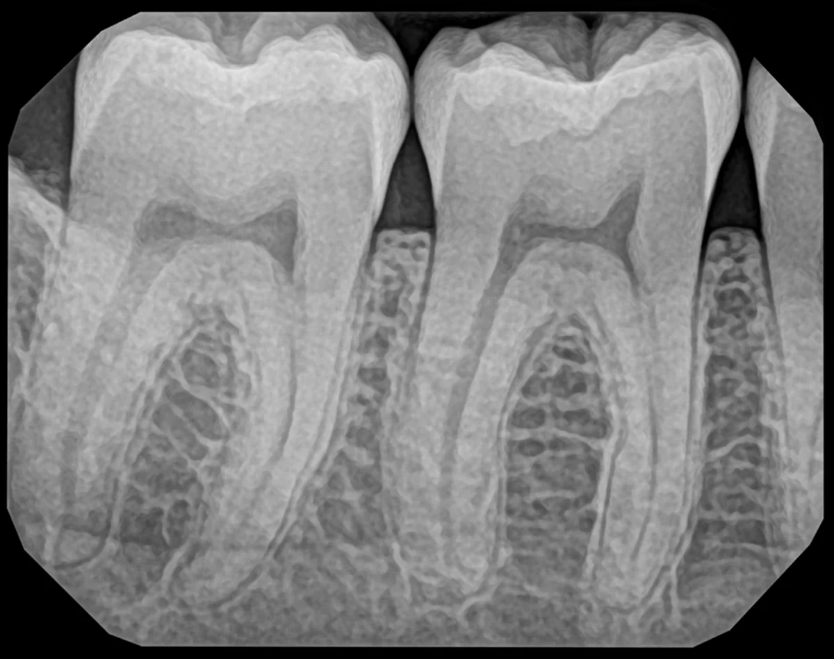 Bitewing X-ray taken with the DentiMax Pro sensor